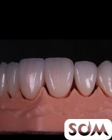 Скидки! Металлокерамика, цирконий. Импланты Южная Корея